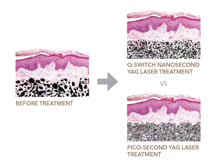 Astria Medical Aesthetics: About Pico