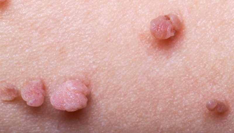 Astria Medical Aesthetics: About Skin Tags