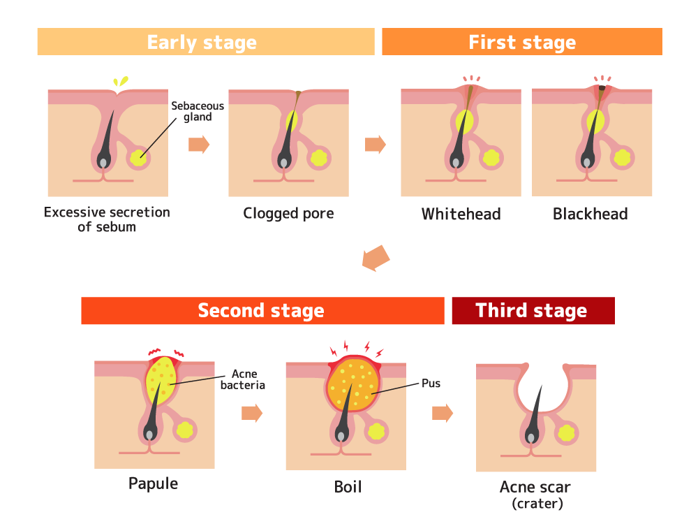 Astria Medical Aesthetics: Acne types