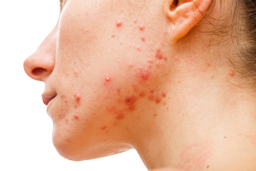 Astria Medical Aesthetics: Causes of Acne