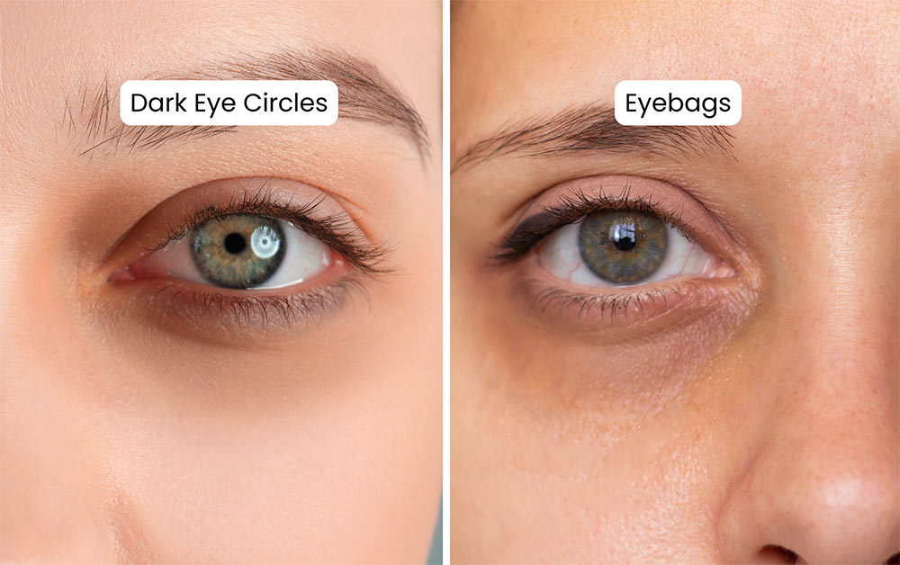 Astria Medical Aesthetics: Dark Eye Circles vs Eyebags
