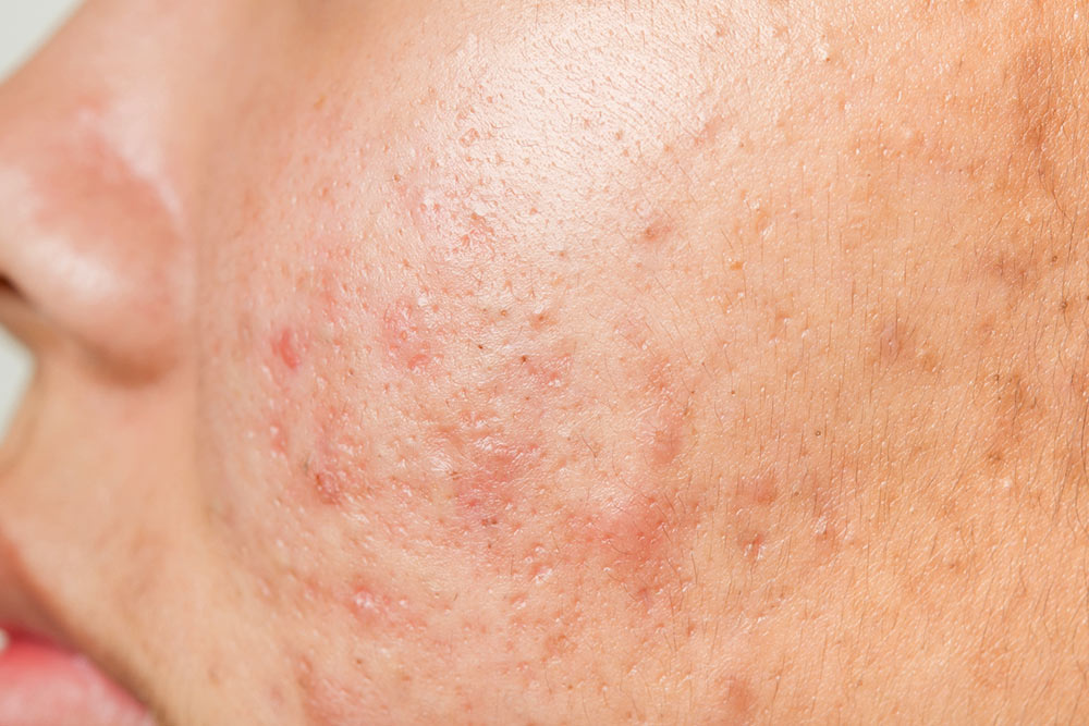 Astria Medical Aesthetics: Complications of Acne