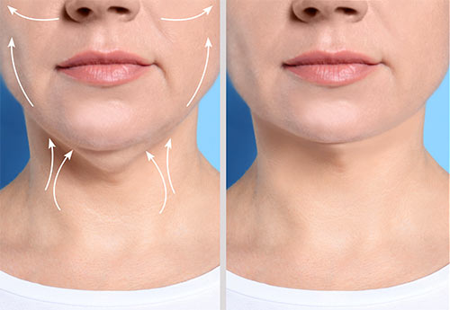 Astria Medical Aesthetics: Double Chin tips
