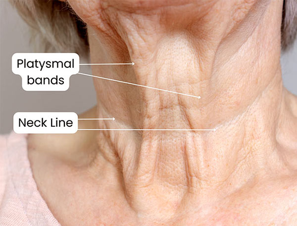 Astria Medical Aesthetics: Neck lines or Platysmal