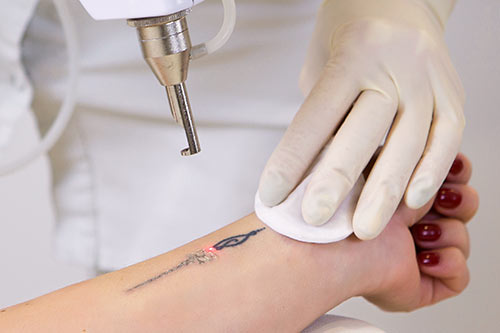 Astria Medical Aesthetics: Pico Laser - Tattoo downtime
