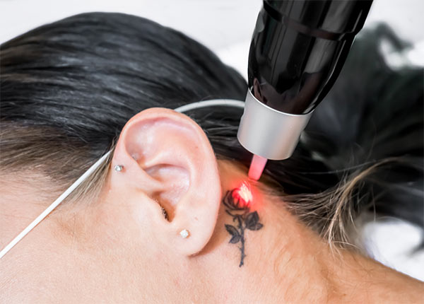 Astria Medical Aesthetics: Pico Laser Tattoo removal