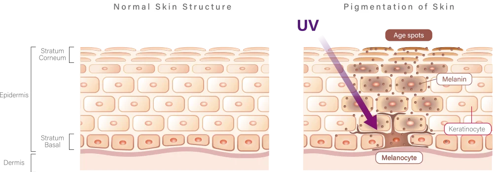 Astria Medical Aesthetics: Causes of Skin Pigmentation