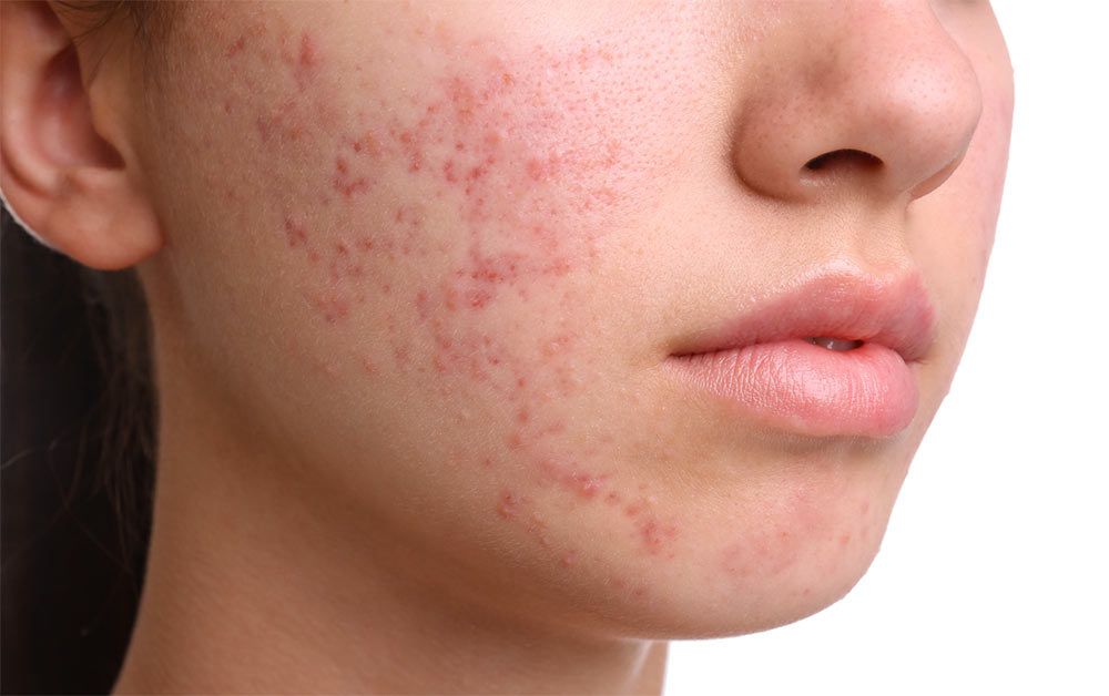 Astria Medical Aesthetics: Acne scars will go away