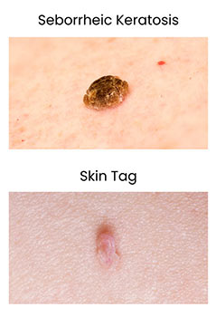 Astria Medical Aesthetics: Seborrheic Keratosis vs Skin Tag