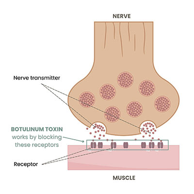 Astria Medical Aesthetics: How BTX/Neurotoxin works