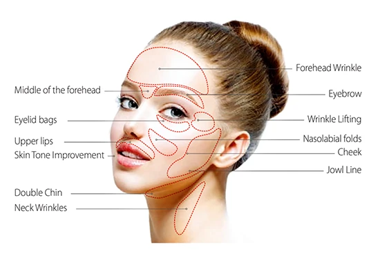 Astria Medical Aesthetics: HIFU targets