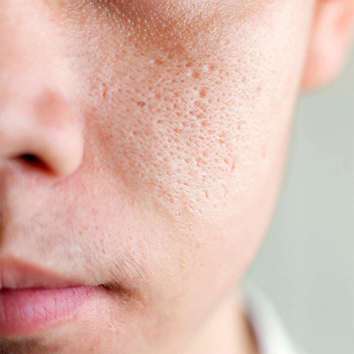 Astria Medical Aesthetics: Enlarged pores