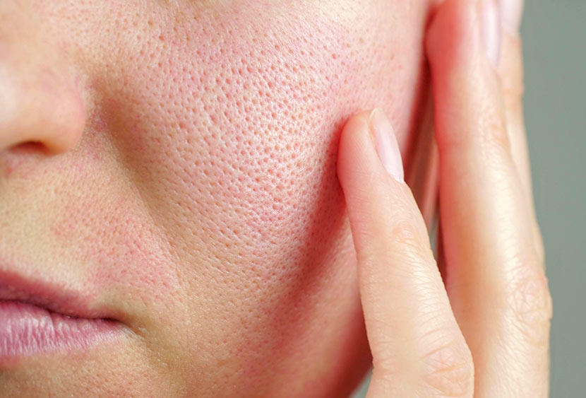 Astria Medical Aesthetics: Why Enlarged Pores