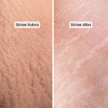 Astria Medical Aesthetics: Striae Rubra vs Striae Alba stretch marks