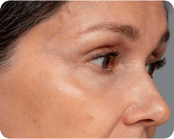 Fine lines and wrinkles