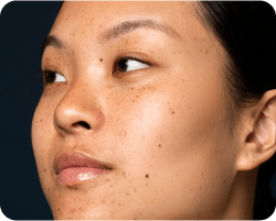 Dull skin tone
