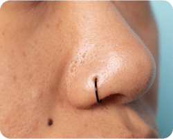 Enlarged pores and Acne scars