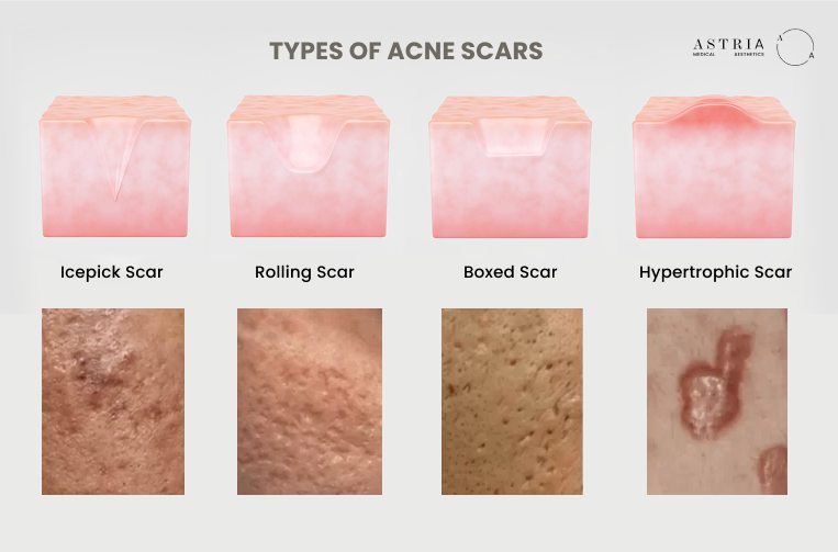 Not all acne scars are the same