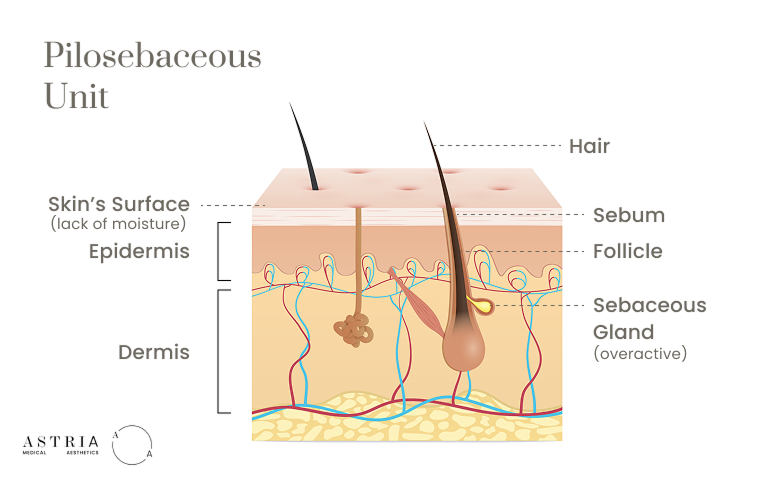 Oily Skin Can Still Be Dehydrated
