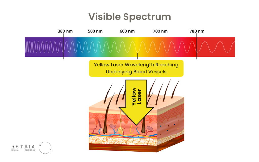 Yellow laser targets the overactive blood vessels