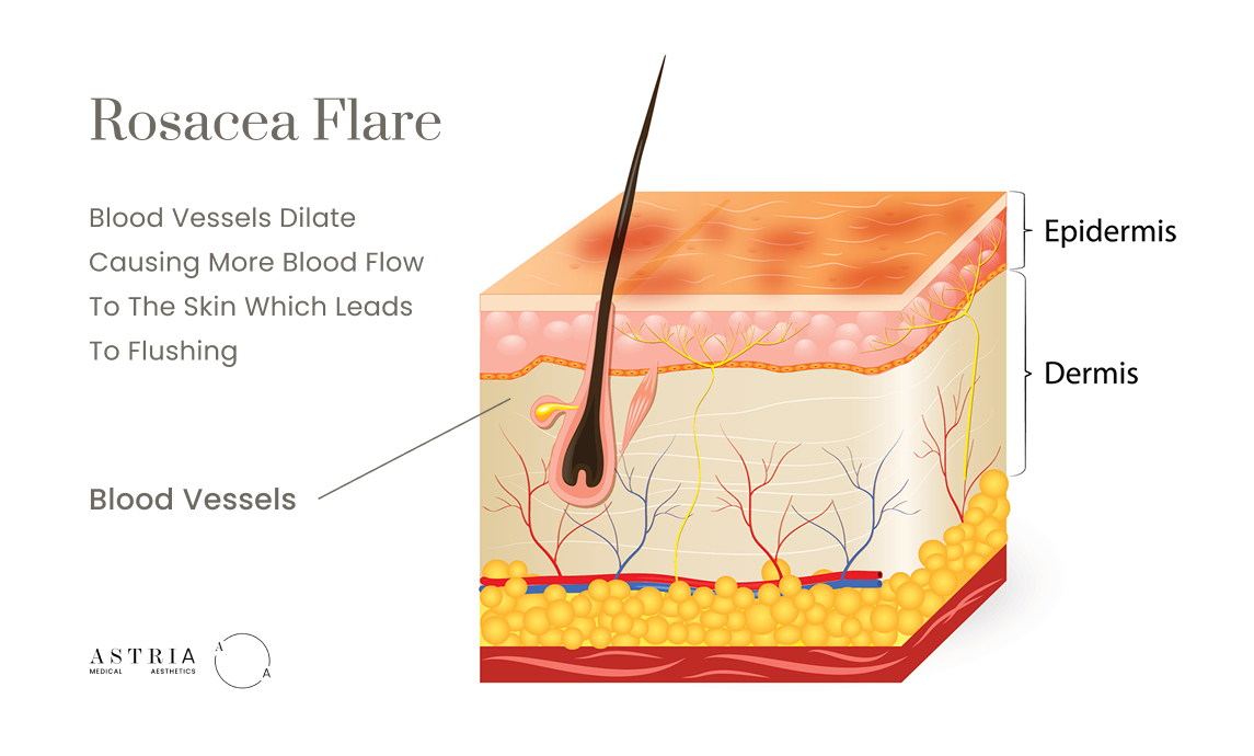 Rosacea Flare