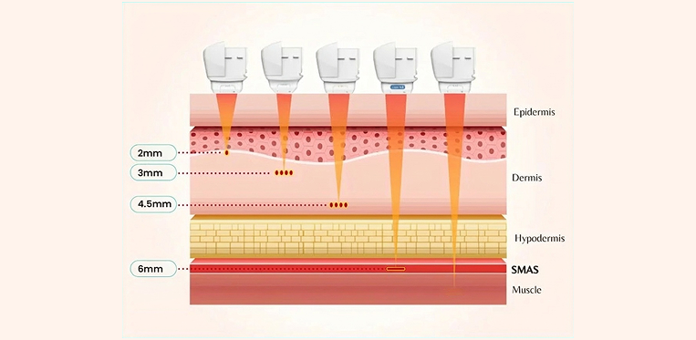 HIFU delivers ultrasound heat energy to multiple layers of the skin