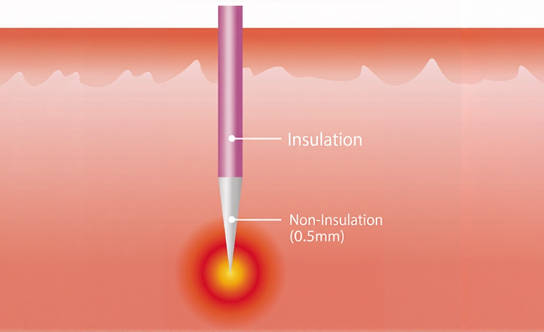 Morpheus8 is a deep RF microneedling device