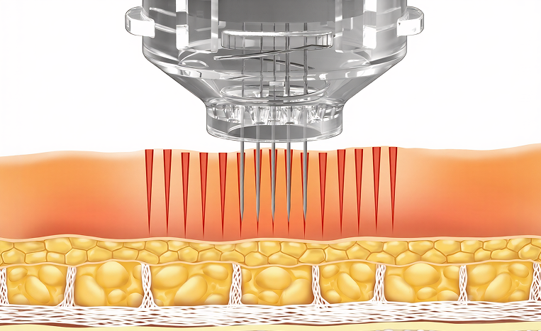The Microneedling
