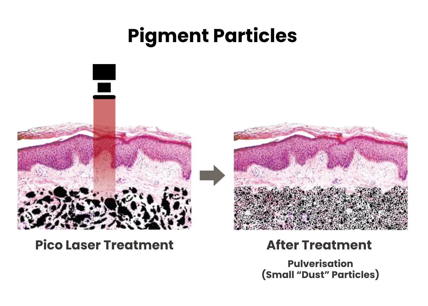 Pico Laser technology