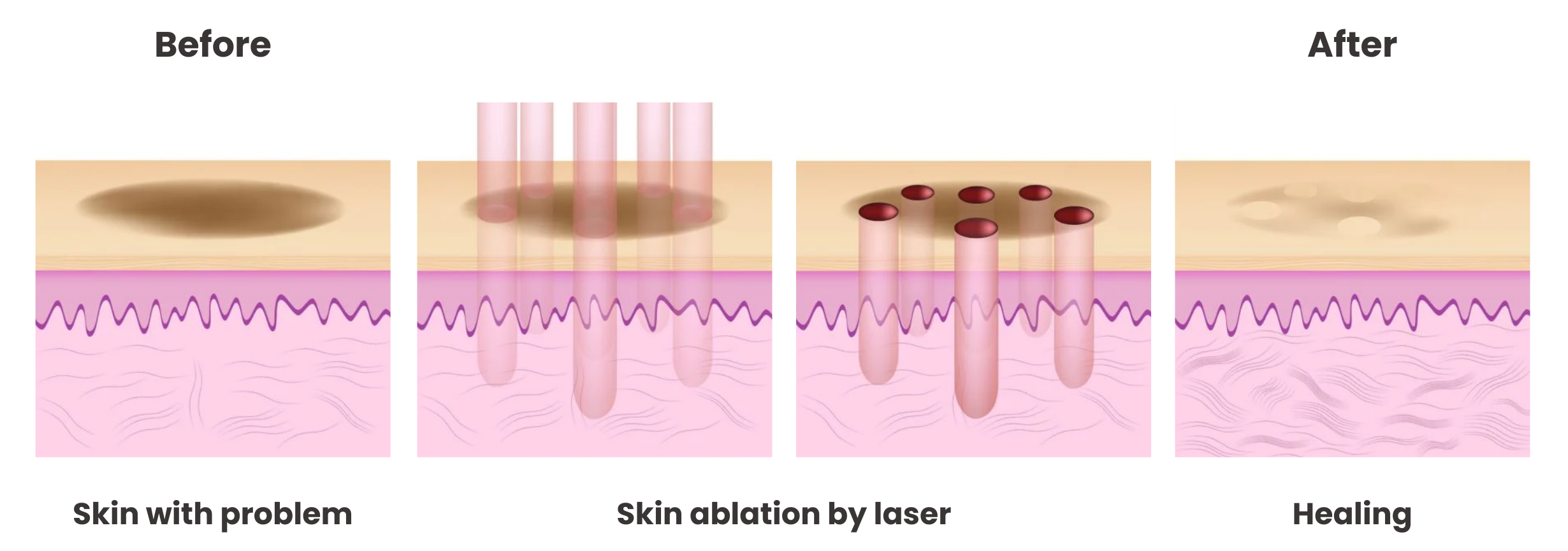 How Does Fractional CO2 Laser Work?