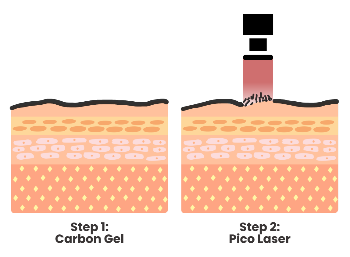 Carbon Laser Process