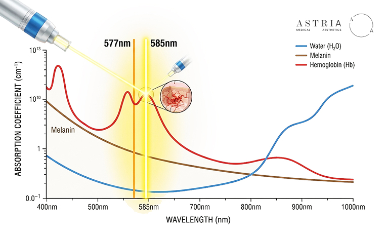 577nm and 585nm Yellow Laser