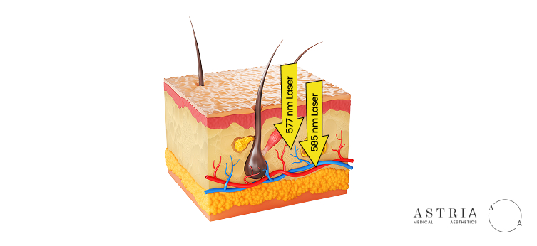 Laser's wavelength