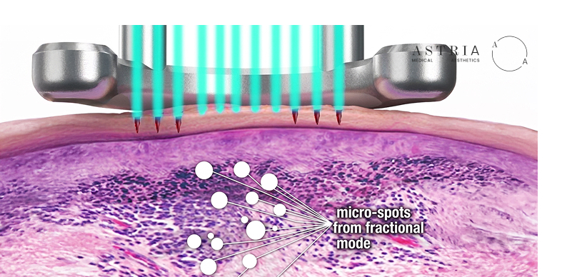 The laser delivers energy in tiny columns or micro-spots under the skin