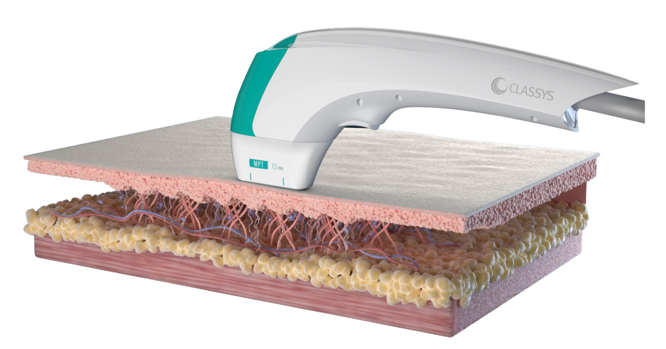 The HIFU device delivers focused ultrasound beams to skin