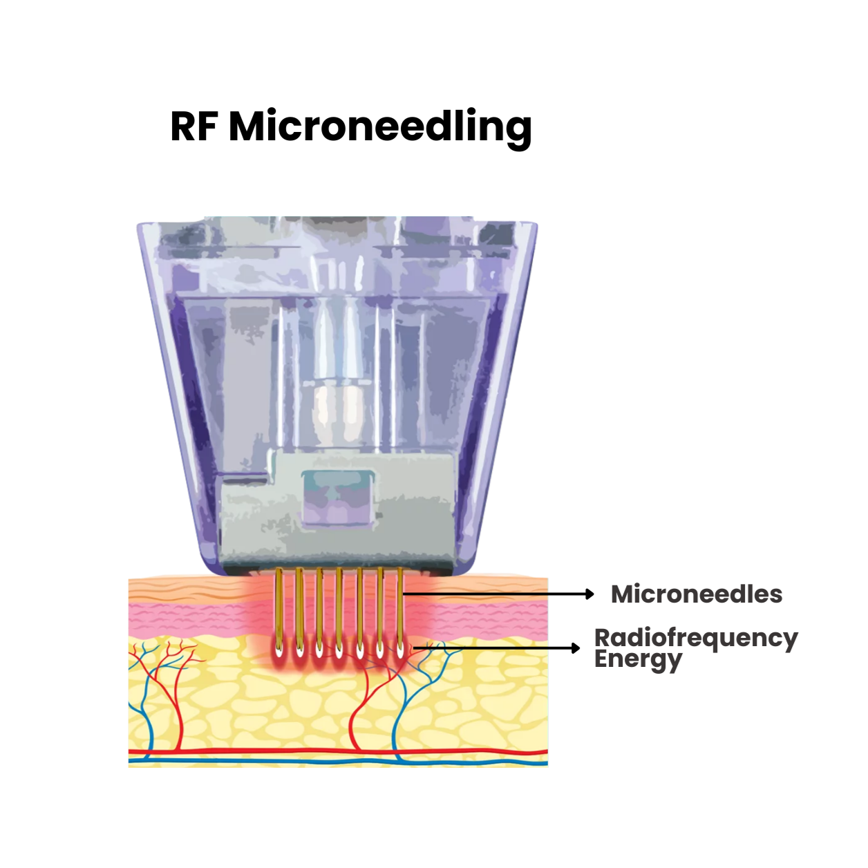 Morpheus8 Treatment Works
