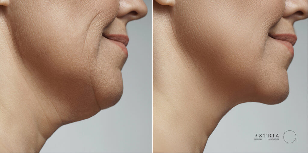 Target fat reduction in heavy areas