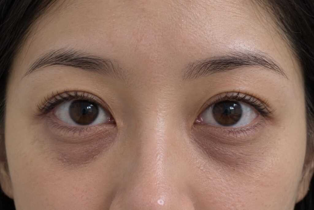 Bluish-purple dark undereyes from thin skin