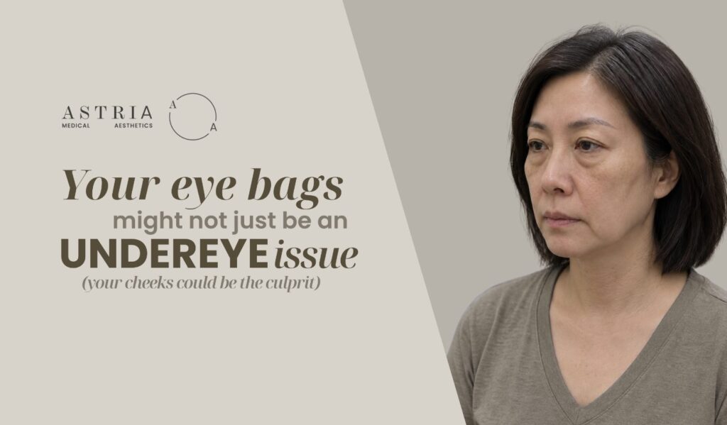 Your eye bags might not just be an undereye issue - your cheeks could be the culprit