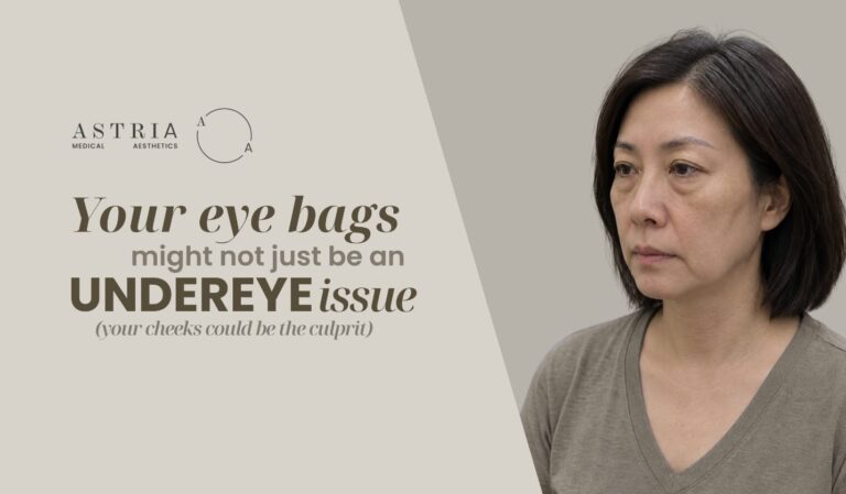 Your eye bags might not just be an undereye issue - your cheeks could be the culprit