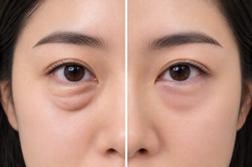Comparison of under-eye bags caused by fat versus fluid