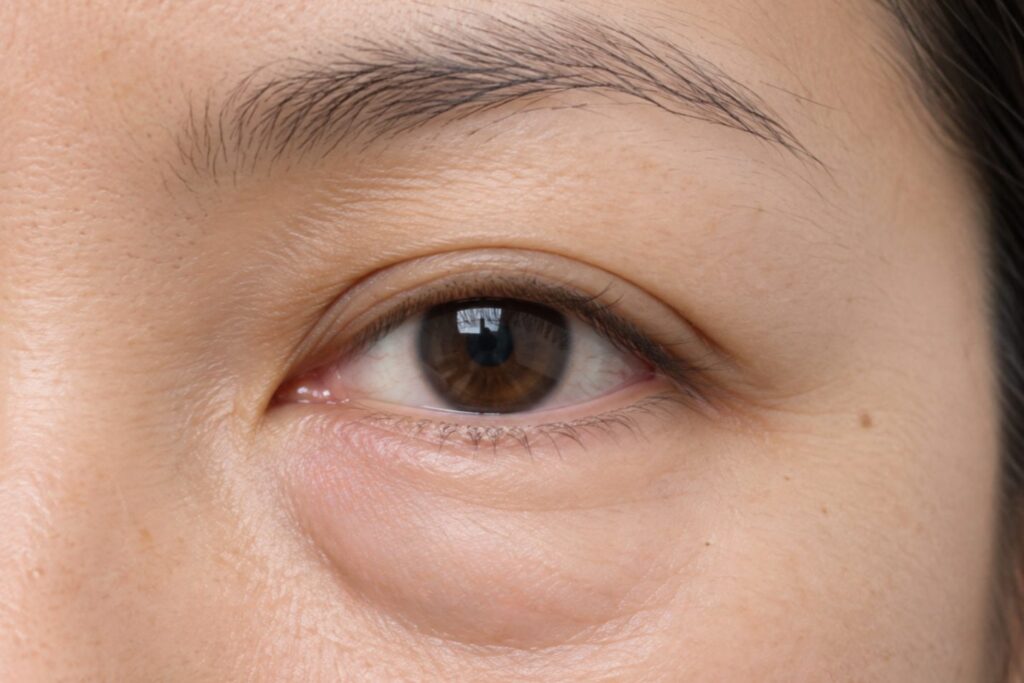 Mild under-eye swelling after PDLLA Collagen Skin Booster