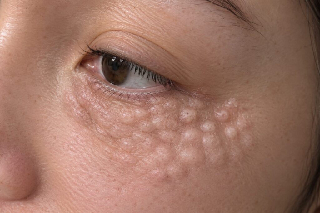 Temporary surface bumps under the eye after PN Eye Booster