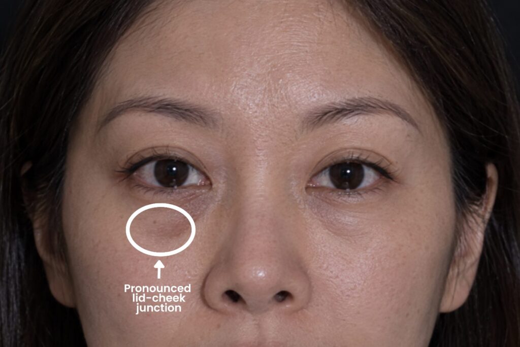 Front view of an Asian woman with a pronounced lid-cheek junction under the eye