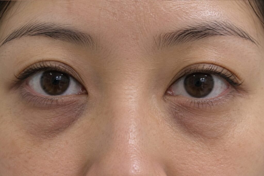 Sunken, hollow undereyes casting shadows