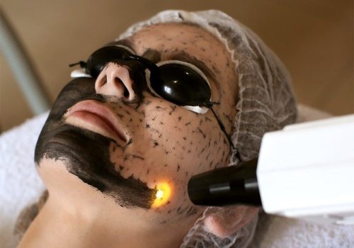 Astria Medical Aesthetics: About Carbon Laser Peel