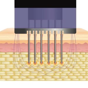 How Does Morpheus8 Treatment Work?