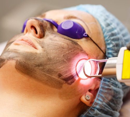 Astria Medical Aesthetics: Carbon Laser Peel benefits