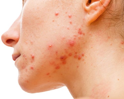 Astria Medical Aesthetics: Causes of Acne