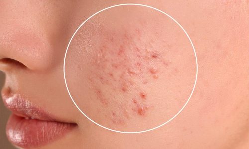 Astria Medical Aesthetics: Carbon Laser Peel treatment
